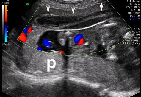 What Is Placenta Abruption