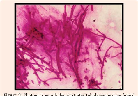 Diagnosis and Management of Pseudomembranous Candidiasis | Semantic Scholar