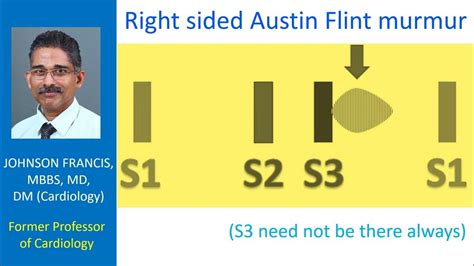 Right sided Austin Flint murmur - YouTube