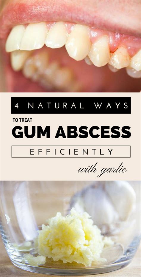 4 Natural Ways To Treat Gum Abscess Efficiently With Garlic in 2020 | Healthy advice, Teeth ...