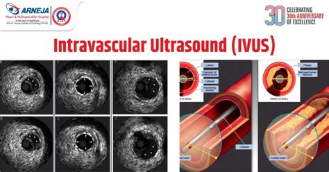 Intravascular Ultrasound (IVUS) - Heart Hospital in Nagpur