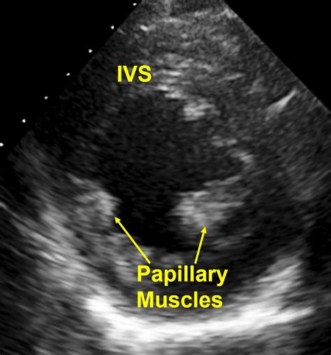 Papillary muscles – echocardiogram – All About Cardiovascular System and Disorders