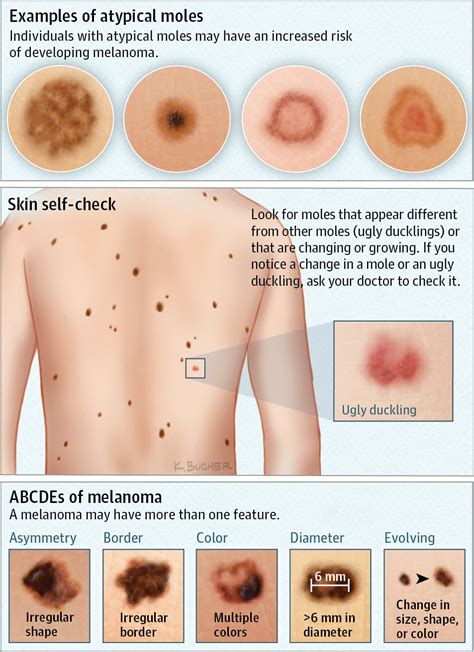 Atypical Moles. | Dermatology | JAMA Dermatology | JAMA Network