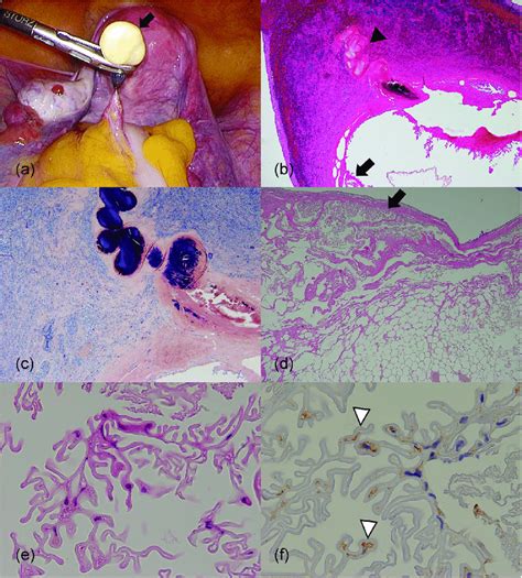 Intra-operative and histologic findings of the epiploic appendage... | Download Scientific Diagram