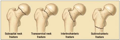 Three main types of hip fractures: femoral neck fracture (subcapital... | Download Scientific ...