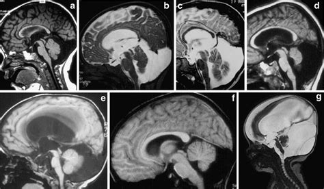 a-g Mega cisterna magna (or Dandy-Walker malformation type B of... | Download Scientific Diagram