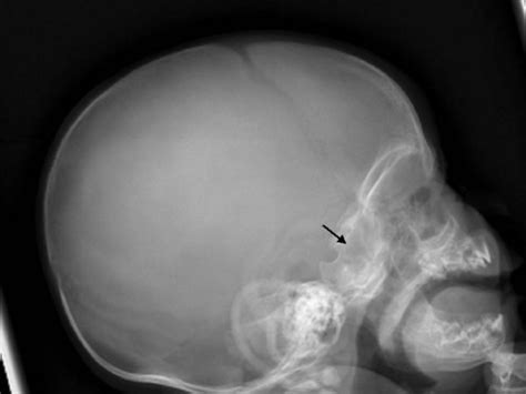 Lateral skull radiograph showed sclerosis of the skull base and hyperostosis of the calvaria ...