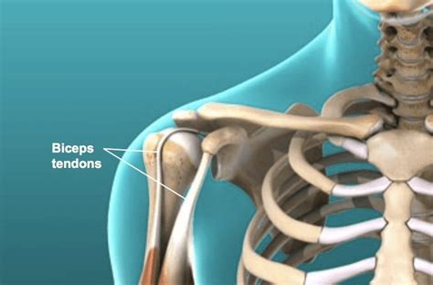 Biceps Tenodesis Surgery in Florida | Schedule a Consultation Today