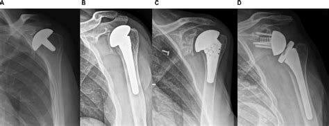 various glenohumeral arthroplasties. Note: (A) Humeral inlay ...