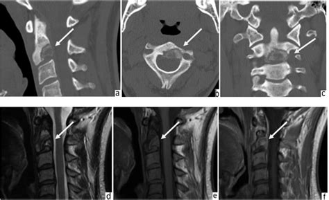 Osteoid osteoma of the cervical spine in a 26 years old female (a ...