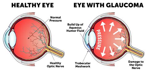 Eye Pressure Chart For Glaucoma