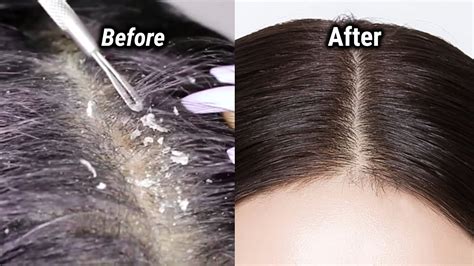 Remove Dandruff In First Wash/Anti Dandruff Treatment #dandruff - YouTube