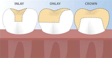 Dental Crowns: Everything You Need To Know Procedure, Cost, and Options. | Peel Dental Studio ...