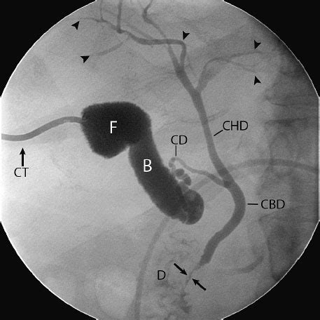 Percutaneous Cholecystostomy | Radiology Key