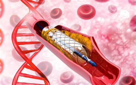 PCI stents & ballooning of coronary arteries | Free consultation