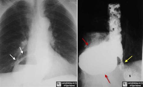 Learning Radiology - Epiphrenic, Diverticulum, giant, huge, esophagus, tic, pulsion, false, distal