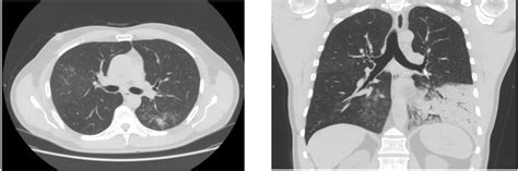 A, B: Axial and coronal views respectively. Initial chest CT scan... | Download Scientific Diagram