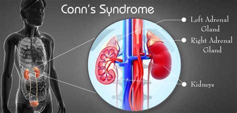 Conn Syndrome - Turkey Istanbul Medical