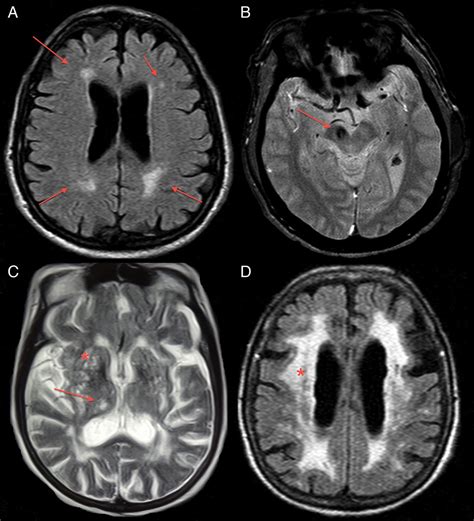 Clinicoradiological comparison between vascular parkinsonism and Parkinson’s disease | Journal ...