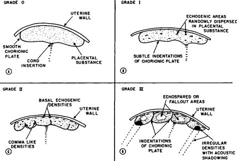 Figure 1 from The value of ultrasonic placental grading: No correlation ...