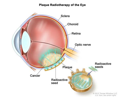 Choroidal Melanoma | What is it, Causes and Treatment