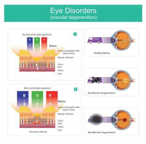 15 Early Signs of Macular Degeneration (Wet vs Dry Macular Degeneratio – GoodLifeProVision