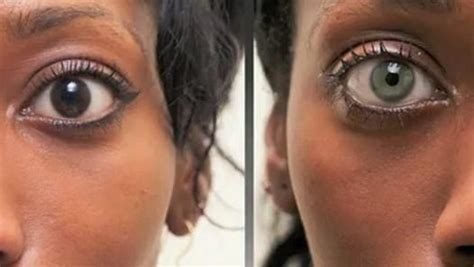 Eye implants that change your iris color. | Pinterest | Surgery, Iris ...