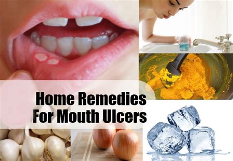 Perfect Home Remedies For Mouth Ulcers - Life Health Max