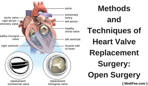 Surgery For Heart Valve Replacement