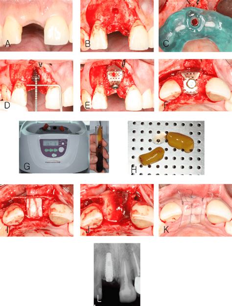 Plastic Surgery On Labia Before And After