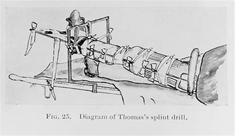 Thomas's splint, fractures. | Wellcome Collection