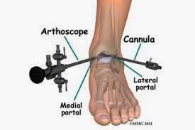 Medical Treatment Pictures-for Better Understanding: Arthroscopic Hip Synovectomy Surgery ...