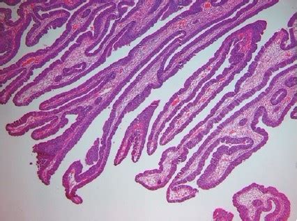 MBBS Medicine (Humanity First): Colon polyps types description and their progression to malignancy