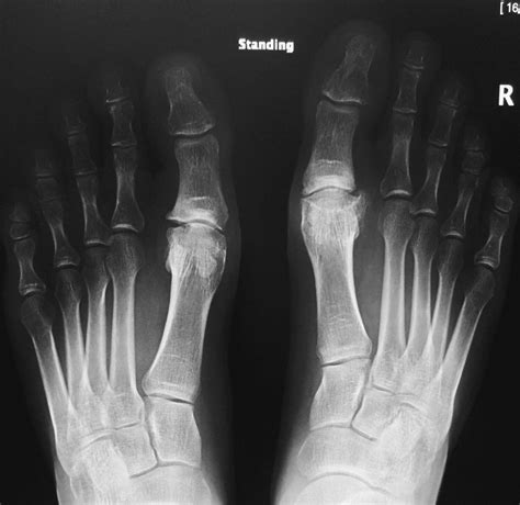 Big Toe Arthritis - Footcare Friday: Alpine Orthopedics and Sports ...