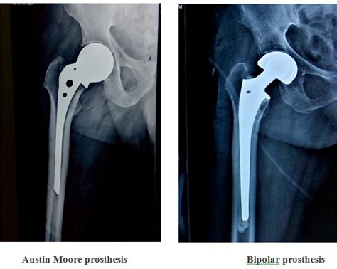 Results of Unipolar v/s Bipolar (fixed) prosthesis in hemireplacement arthroplasty in neck femur ...