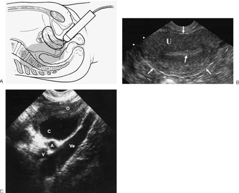 NORMAL ANATOMY OF THE FEMALE PELVIS AND TRANSVAGINAL SONOGRAPHY ...