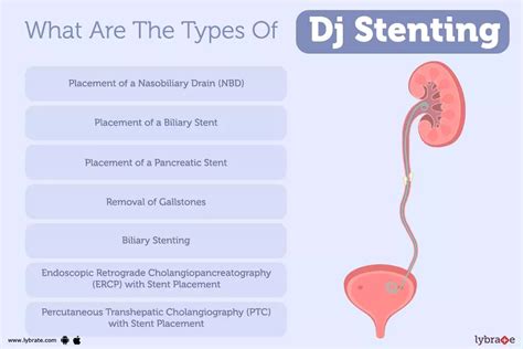 Dj Stenting: Causes, Symptoms, Treatment and Cost