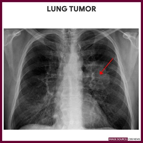 Chest X-ray (Chest Radiography) - Nursing Responsibilities - Nurseslabs