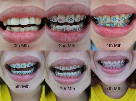 best braces colors to make your teeth look white - Casie Bunker