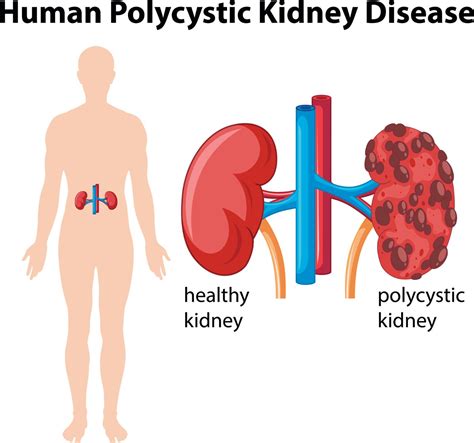 Causes of Kidney Cysts - Facty Health