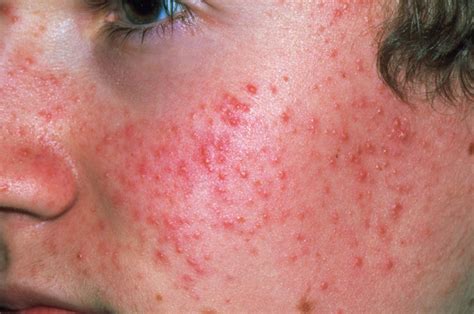 Acne symptoms and diagnosis - HSE.ie