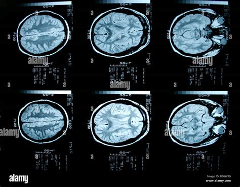 MRI scan of patient's brain with and without contrast agent Stock Photo ...