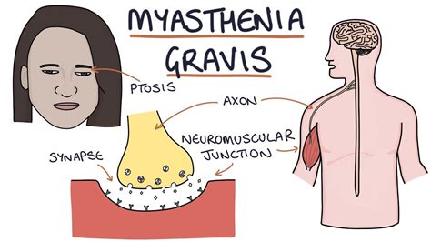 Myasthenia Gravis - YouTube