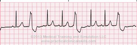 Matters of the Heart - PVCs — PatMac,RN