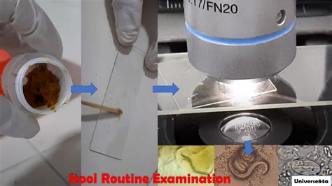 Stool Routine Examination: Introduction, Techniques, Testing Requireme