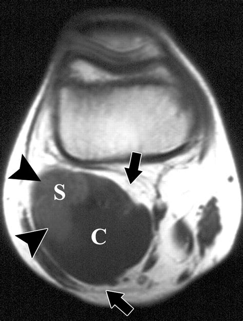 Imaging of Synovial Sarcoma with Radiologic-Pathologic Correlation ...