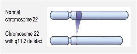22q11.2DS Quick Facts