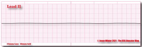 ECG Educator Blog : Asystole