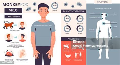 Infografis Cacar Monyet Infeksi Gejala Pencegahan Penyakit Cacar Monyet Ilustrasi Vektor Datar ...