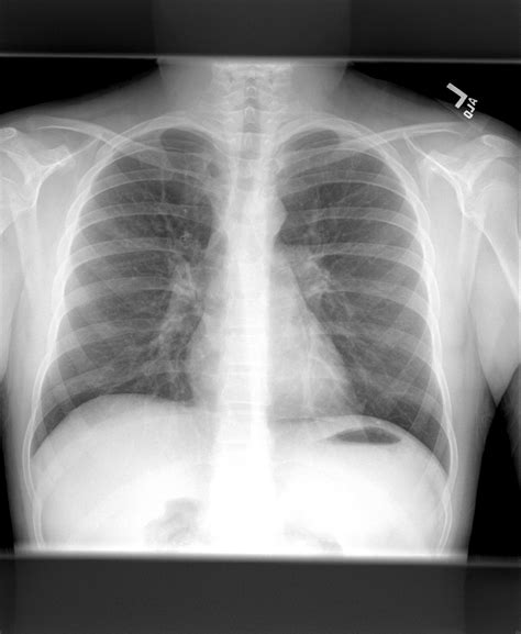 Pediatric Asthma Chest X Ray | SexiezPix Web Porn